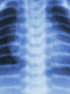 New Methods Needed for Lung Injury Prevention