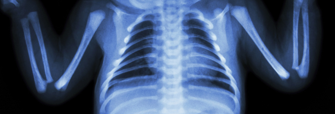New Methods Needed for Lung Injury Prevention